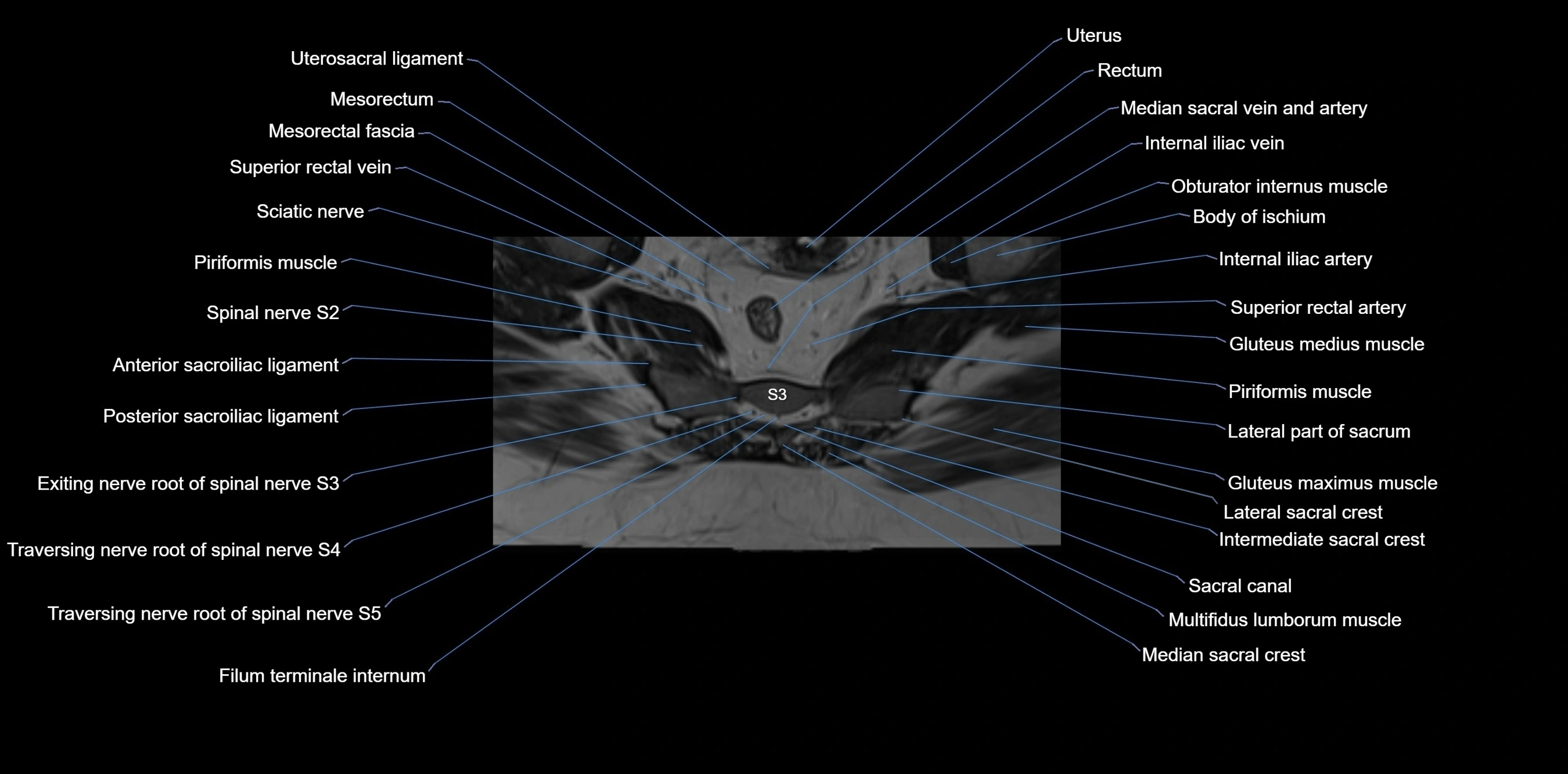 MRI sacrum, coccyx and sacroiliac joint axial cross sectional anatomy 3T  radiology  image-img-00001-00040.webp